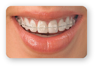 Aparat Dentar Transparent Safir