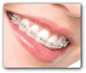 aparat dentar ceramic